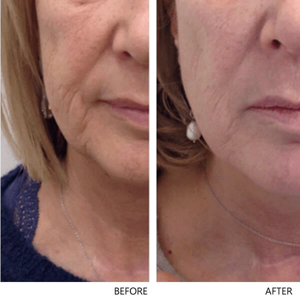 Non-Surgical Facelift – Skin Tightening & Anti-Ageing